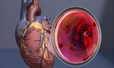 Stress cardiac MRI tests may help improve angina diagnosis and treatment