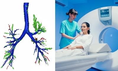 AI spots hidden objects lodged in patients' airways on CT