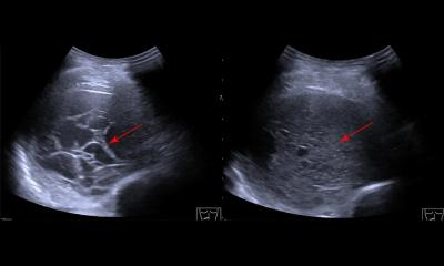Ultrasound update for organ imaging