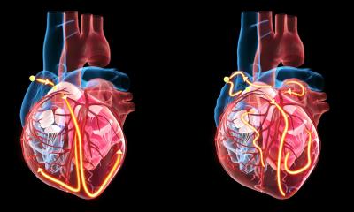 Atrial fibrillation: social inequity persists
