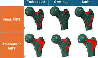 Predicting hip fractures from just 7% of the bone