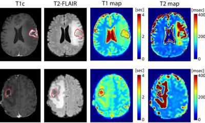 Brain tumour or radiation necrosis? AI can tell them apart
