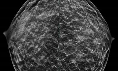 Alarming number of invasive breast cancers in younger women