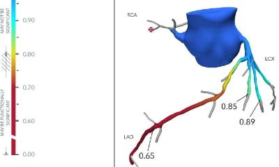 FFR-CT: AI tool predicts heart attack risk in angina patients