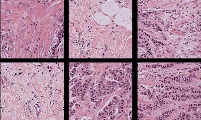 Demographic bias creeps into pathology AI, study finds