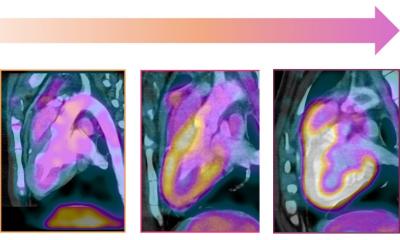 Common chemo drug increases risk of heart damage study finds